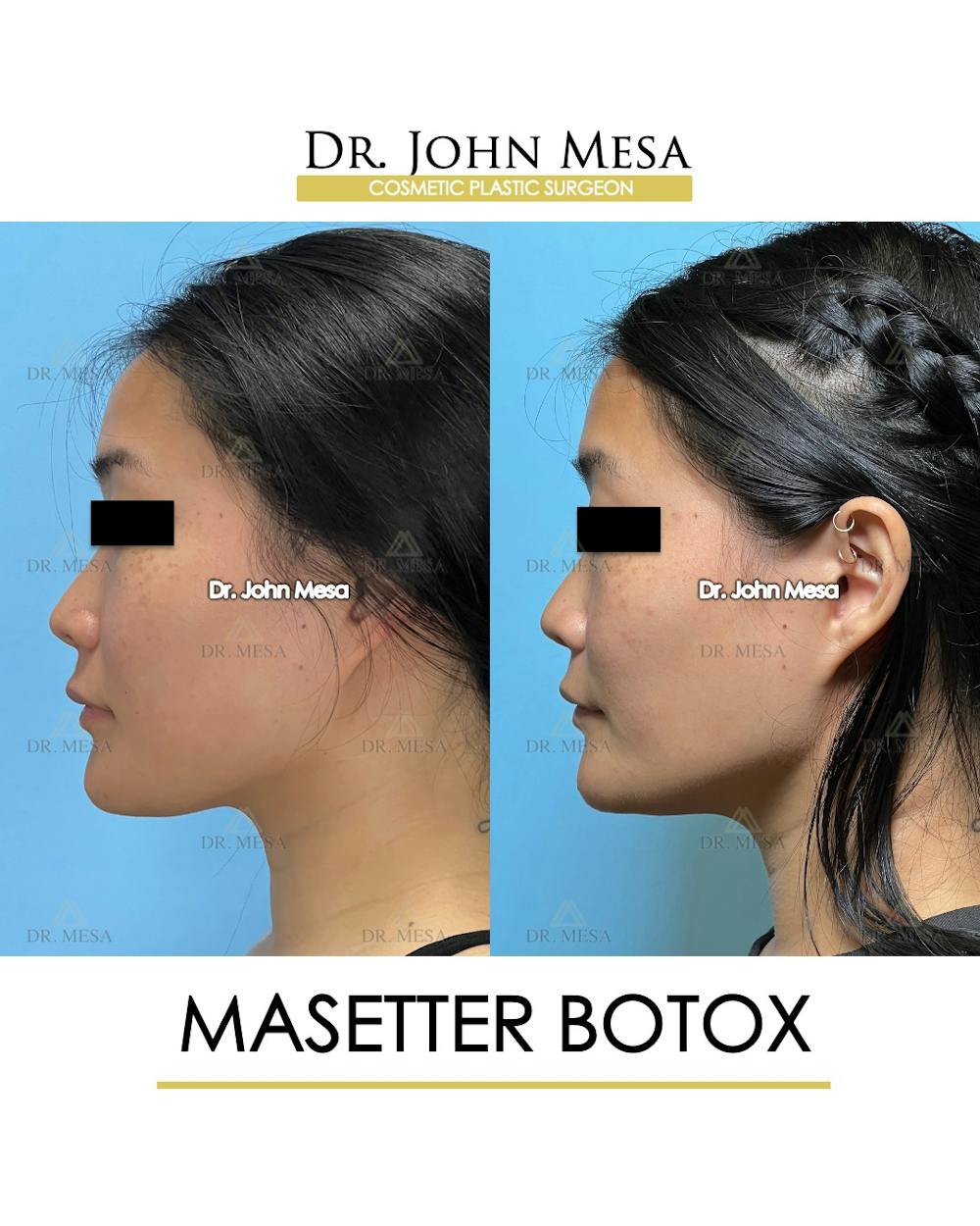 Botox Before & After Gallery - Patient 174966890 - Image 5