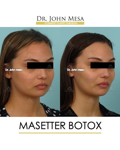 Botox Before & After Gallery - Patient 174911876 - Image 2