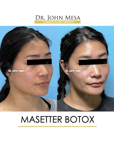Botox Before & After Gallery - Patient 174966890 - Image 2