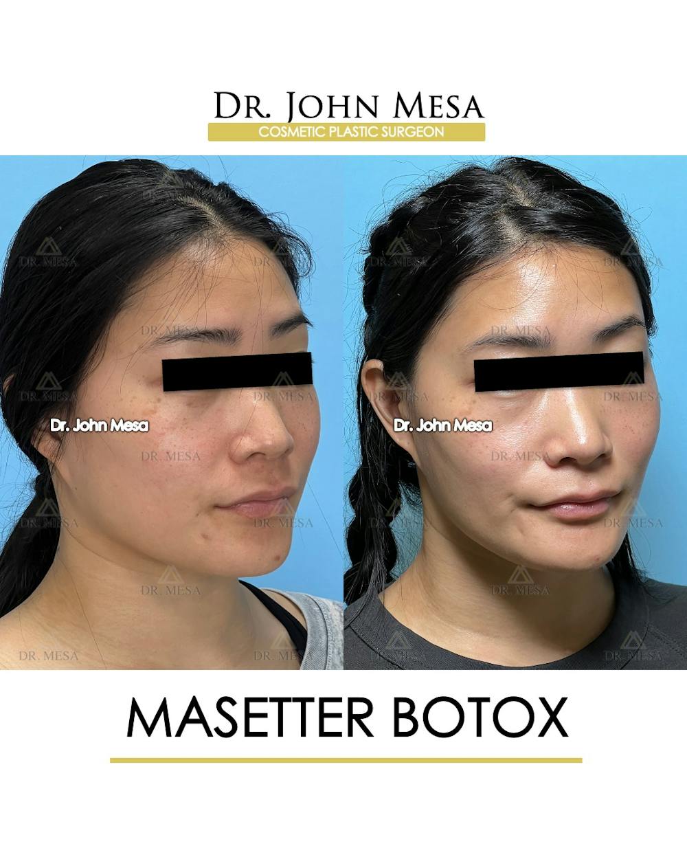 Botox Before & After Gallery - Patient 174966890 - Image 2