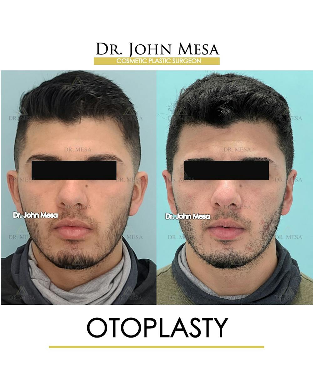 Otoplasty Before & After Gallery - Patient 177159148 - Image 1
