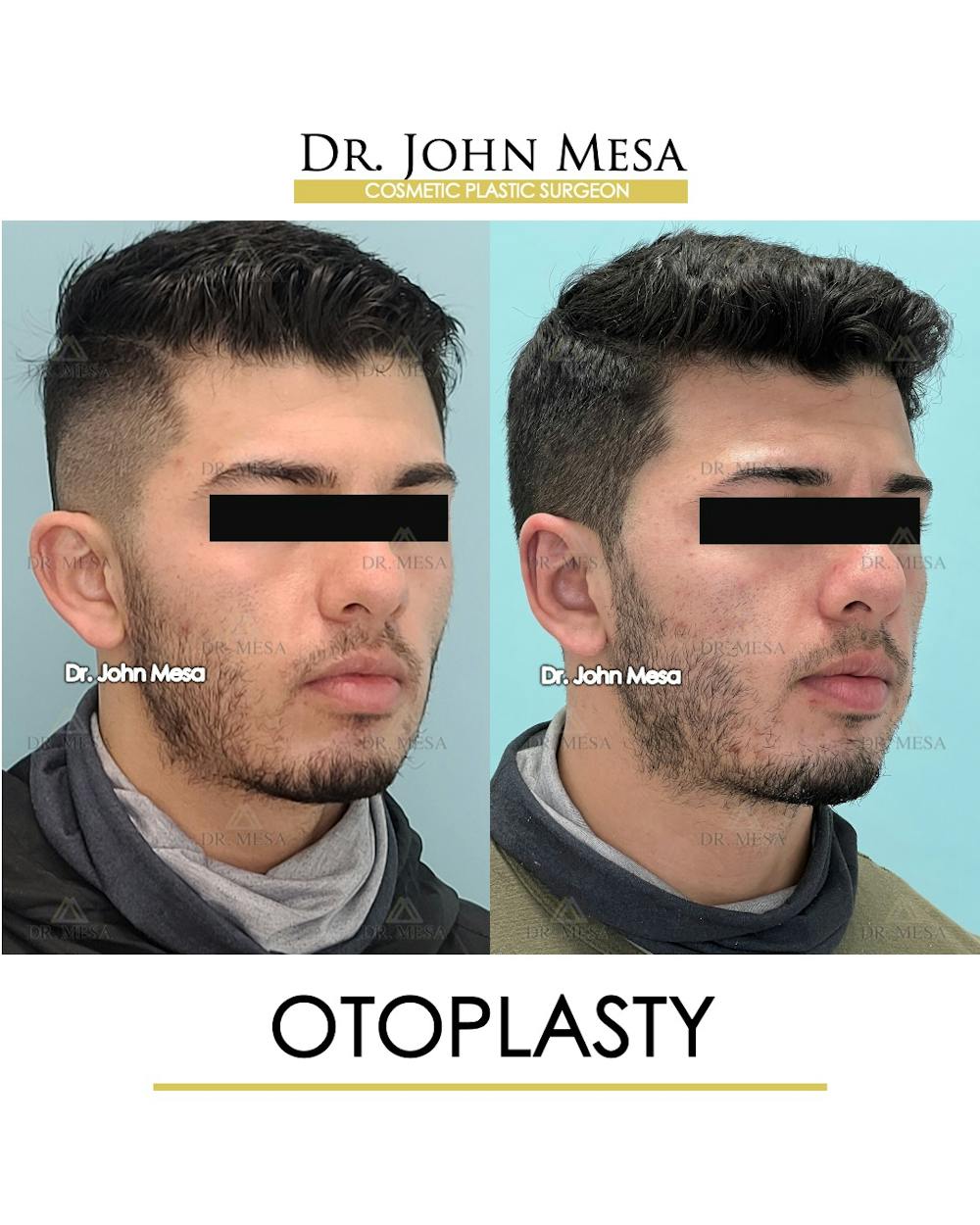 Otoplasty Before & After Gallery - Patient 174971347 - Image 2