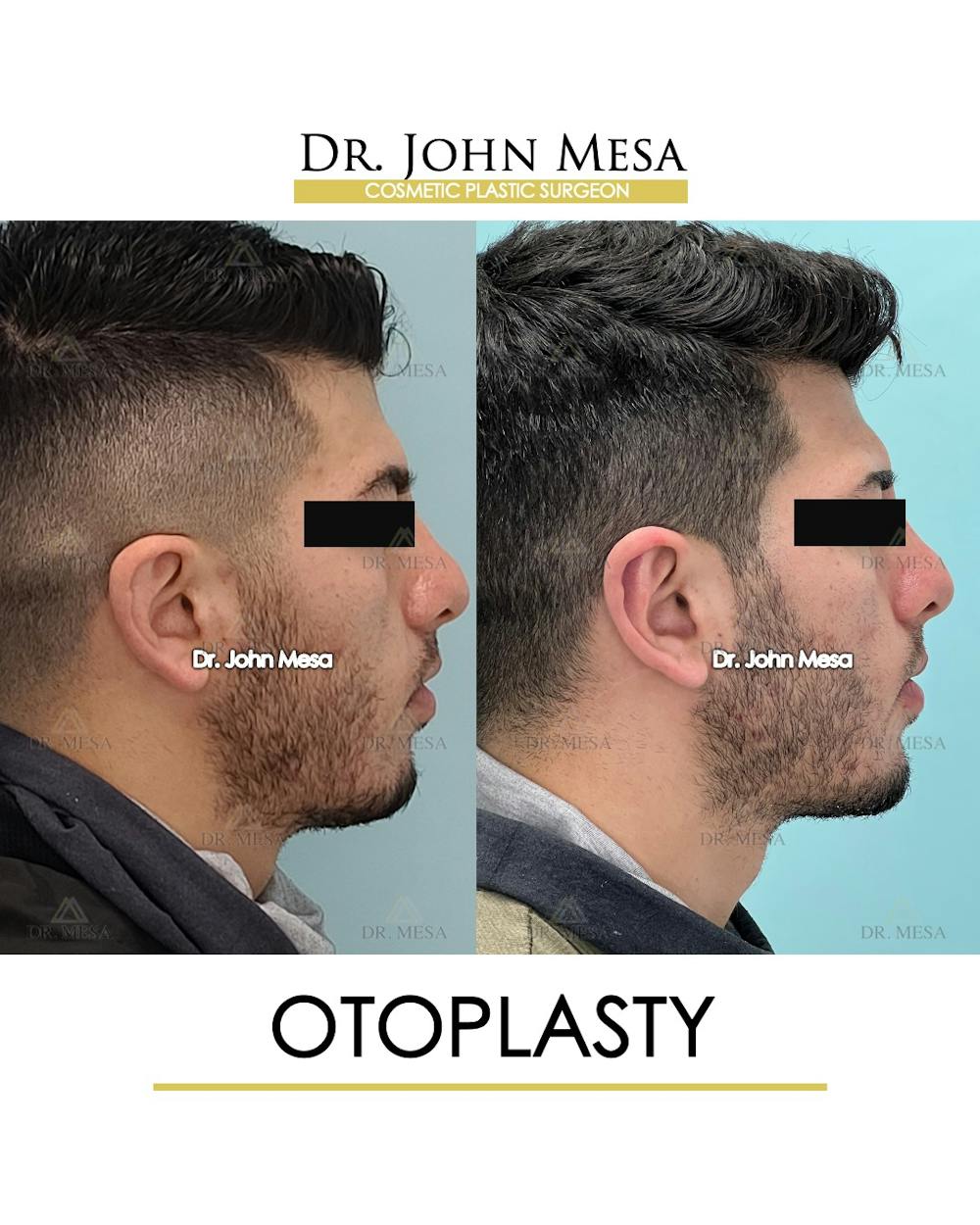 Otoplasty Before & After Gallery - Patient 174971347 - Image 3