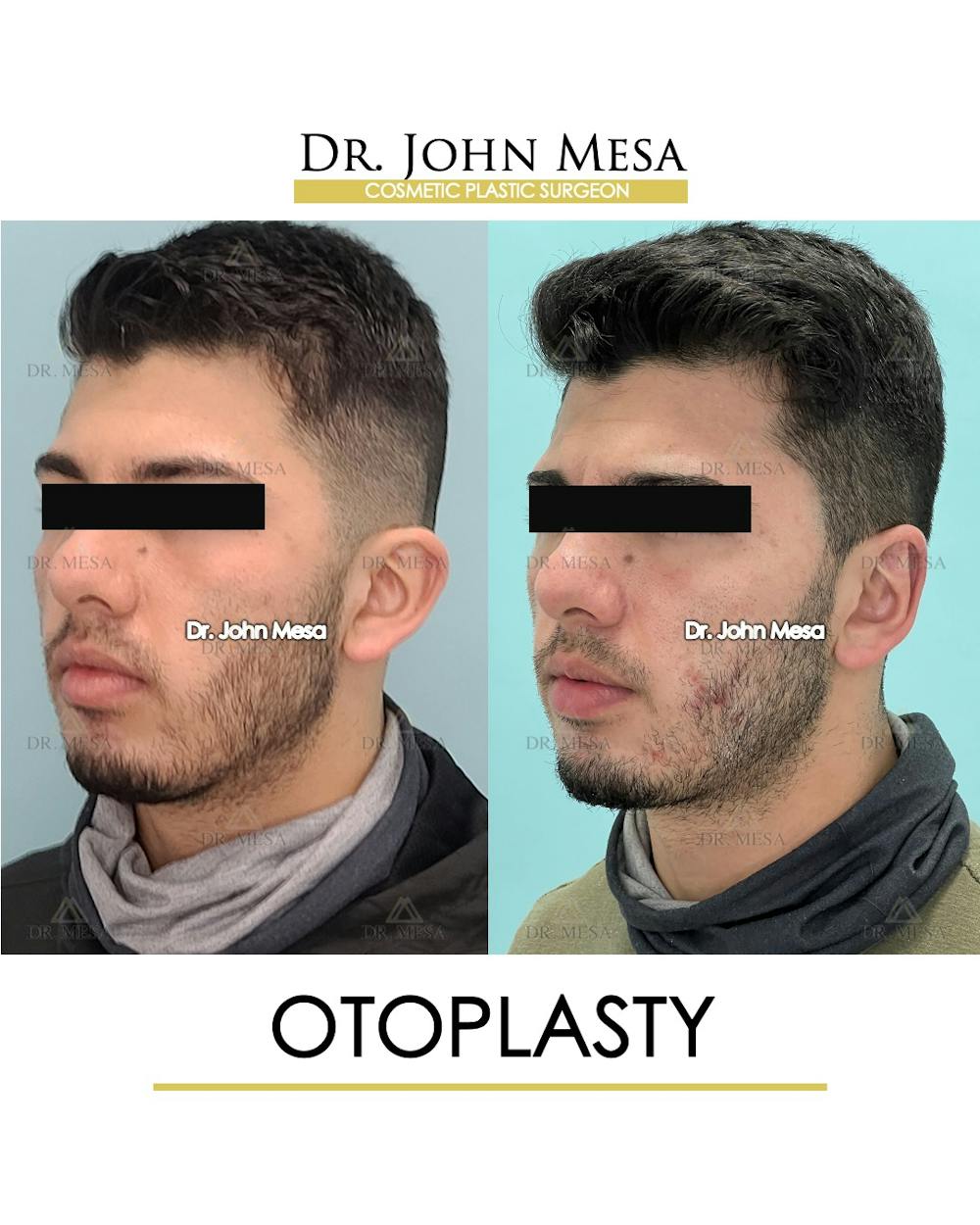 Otoplasty Before & After Gallery - Patient 177159148 - Image 4