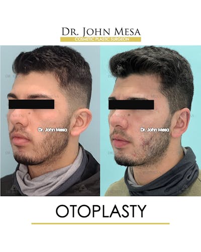 Otoplasty Before & After Gallery - Patient 174971347 - Image 4