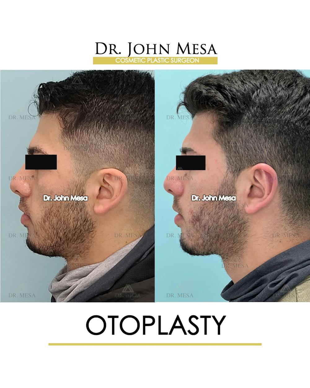 Otoplasty Before & After Gallery - Patient 174971347 - Image 5