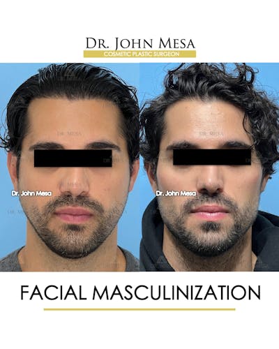 Facial Masculinization Before & After Gallery - Patient 177923794 - Image 1