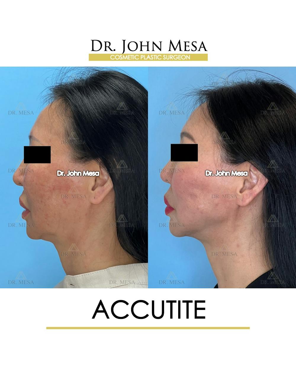 Accutite Before & After Gallery - Patient 264164 - Image 6