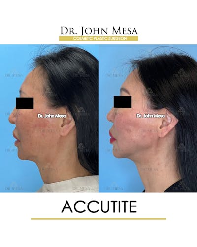 Accutite Before & After Gallery - Patient 264164 - Image 6