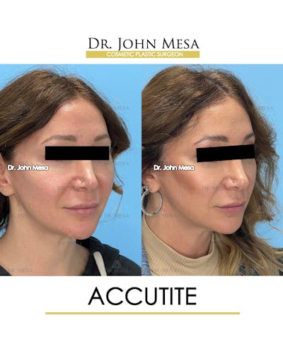 Accutite Before & After Gallery - Patient 156685 - Image 2