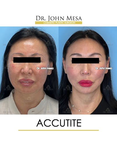 Accutite Before & After Gallery - Patient 264164 - Image 1