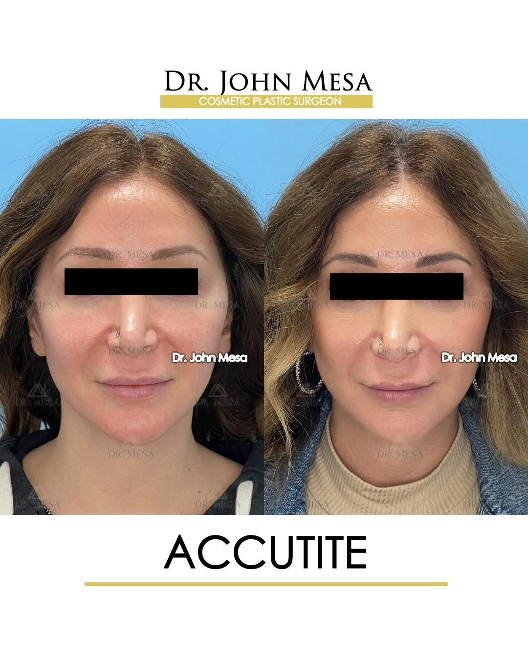 FaceTite Before & After Gallery - Patient 144402 - Image 1