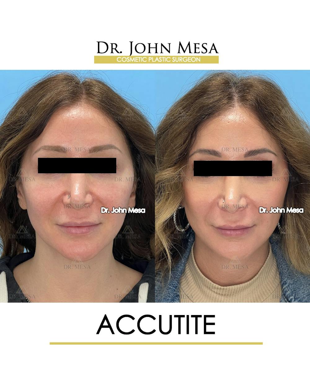 Accutite Before & After Gallery - Patient 156685 - Image 1