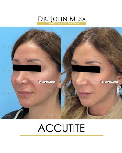 FaceTite Before & After Gallery - Patient 144402 - Image 4