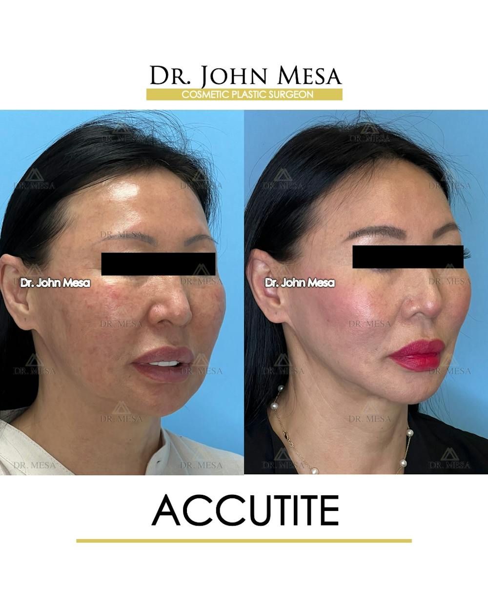 Accutite Before & After Gallery - Patient 264164 - Image 3