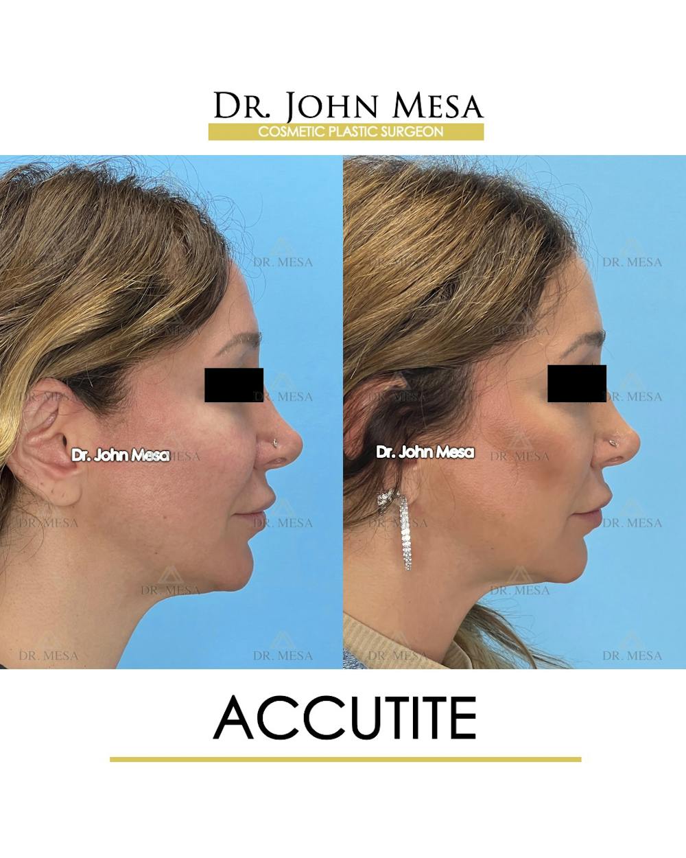 Accutite Before & After Gallery - Patient 156685 - Image 3