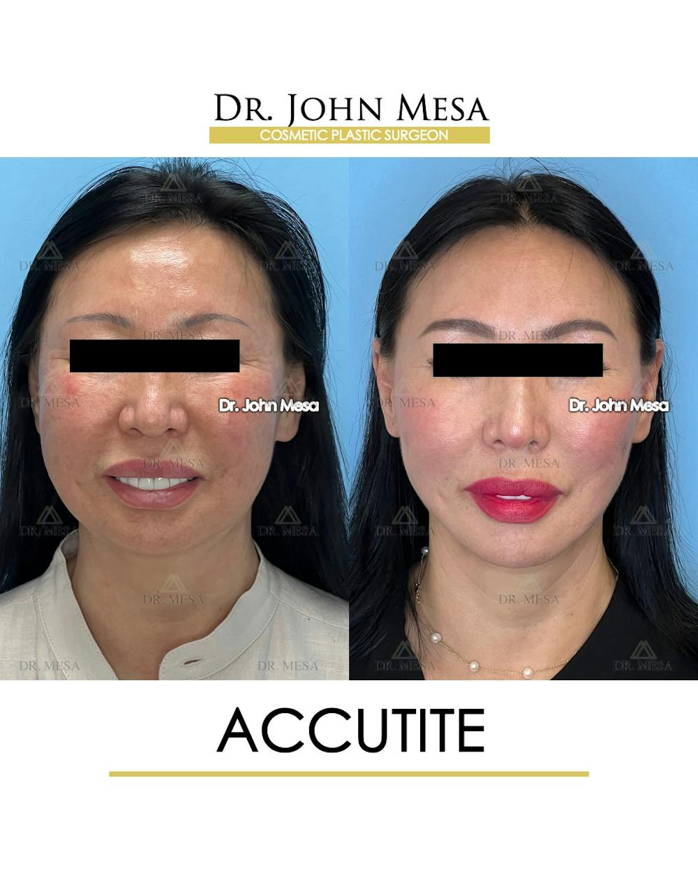 Accutite Before & After Gallery - Patient 264164 - Image 2