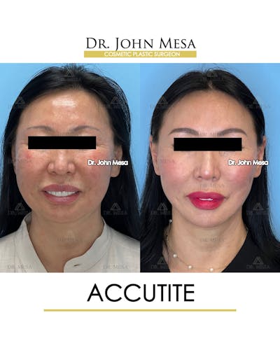 Accutite Before & After Gallery - Patient 264164 - Image 2
