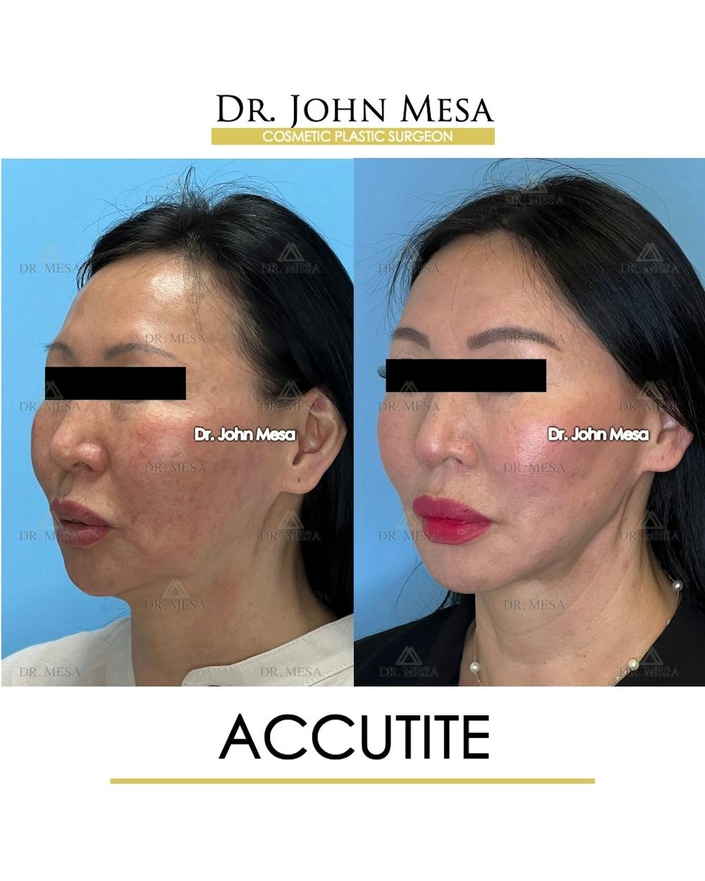 Accutite Before & After Gallery - Patient 264164 - Image 5