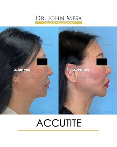 Accutite Before & After Gallery - Patient 264164 - Image 4
