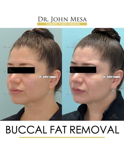 Buccal Fat Pad Removal Before & After Gallery - Patient 291095 - Image 4