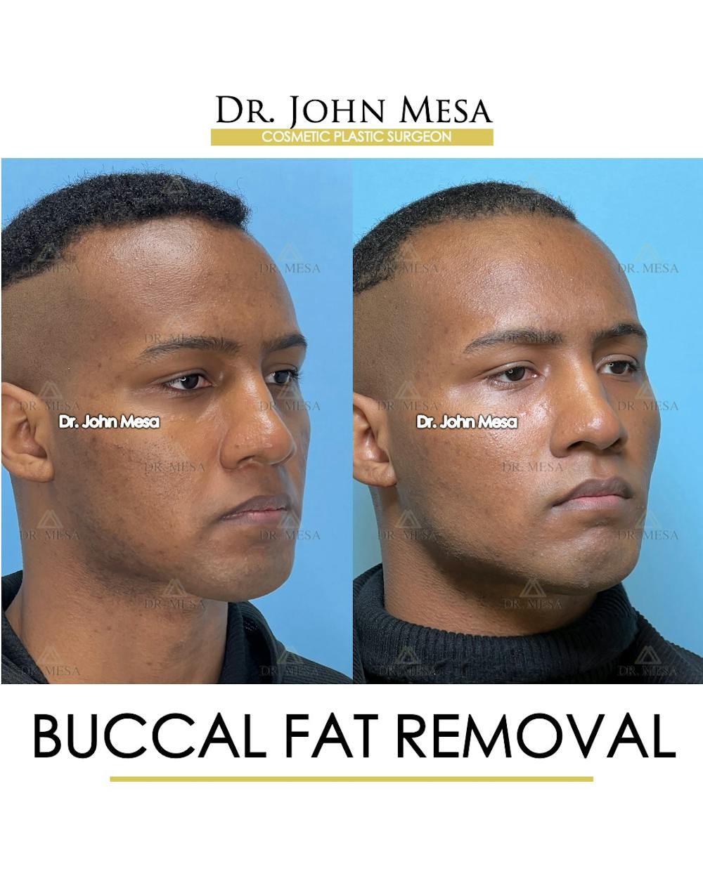 Buccal Fat Pad Removal for Men Before & After Gallery - Patient 187998 - Image 3