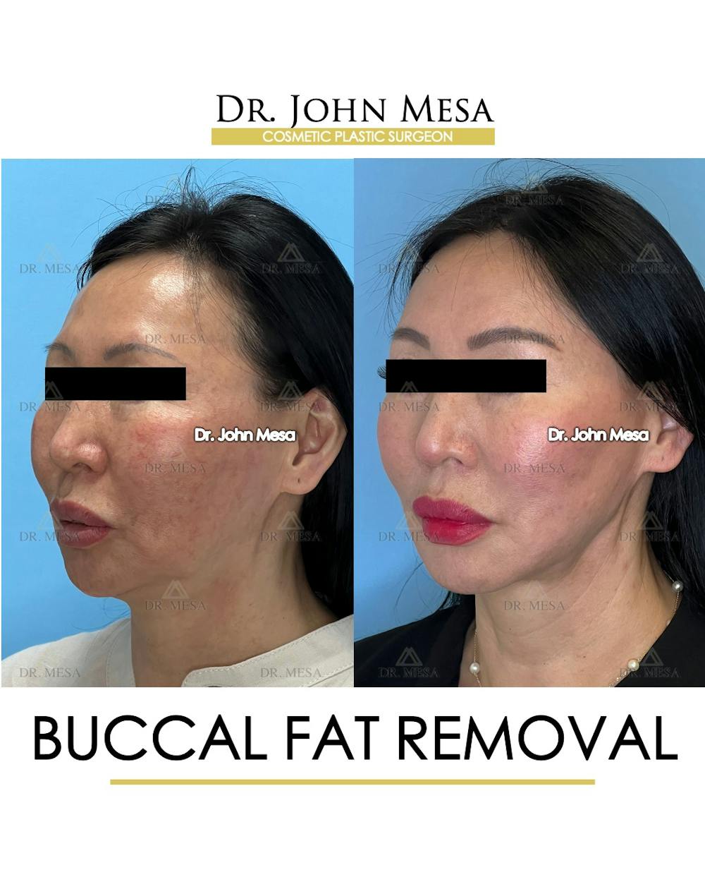 Buccal Fat Pad Removal Before & After Gallery - Patient 797248 - Image 5