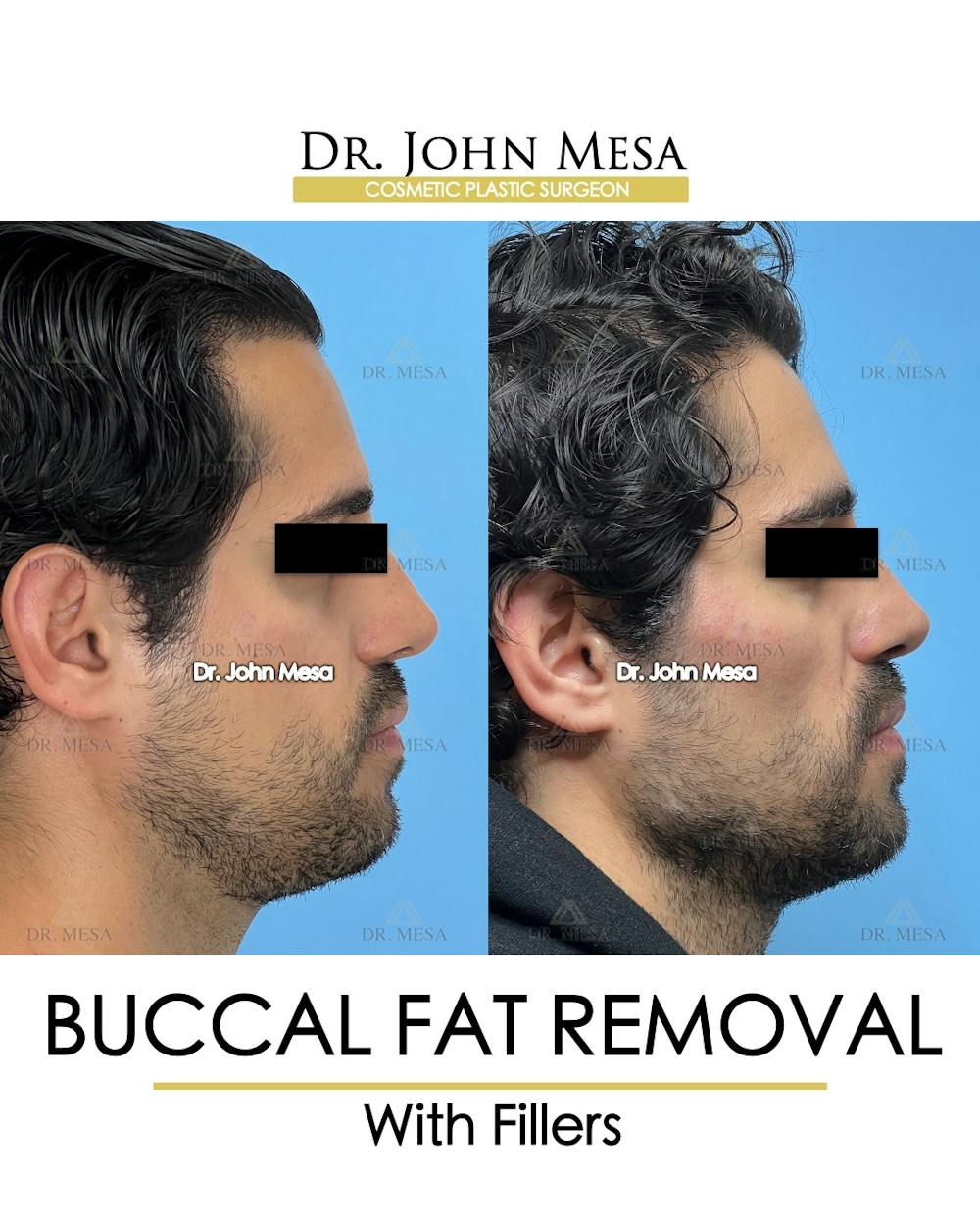 Buccal Fat Pad Removal for Men Before & After Gallery - Patient 404824 - Image 3