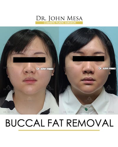 Buccal Fat Pad Removal Before & After Gallery - Patient 889395 - Image 1