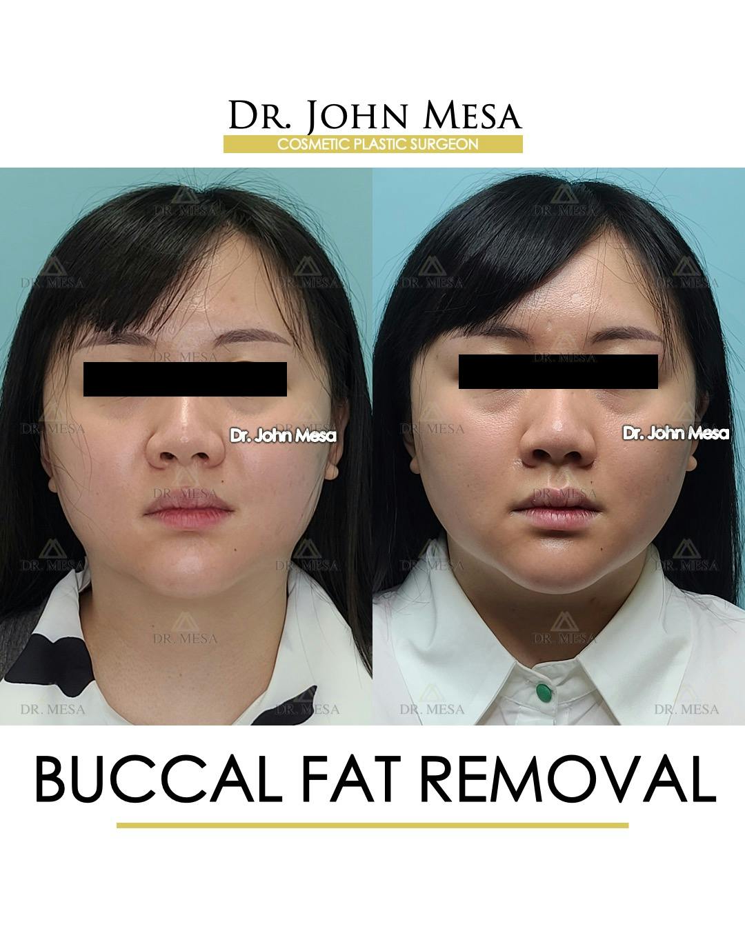 Buccal Fat Pad Removal Before & After Gallery - Patient 889395 - Image 1