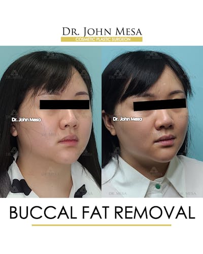 Buccal Fat Pad Removal Before & After Gallery - Patient 889395 - Image 2