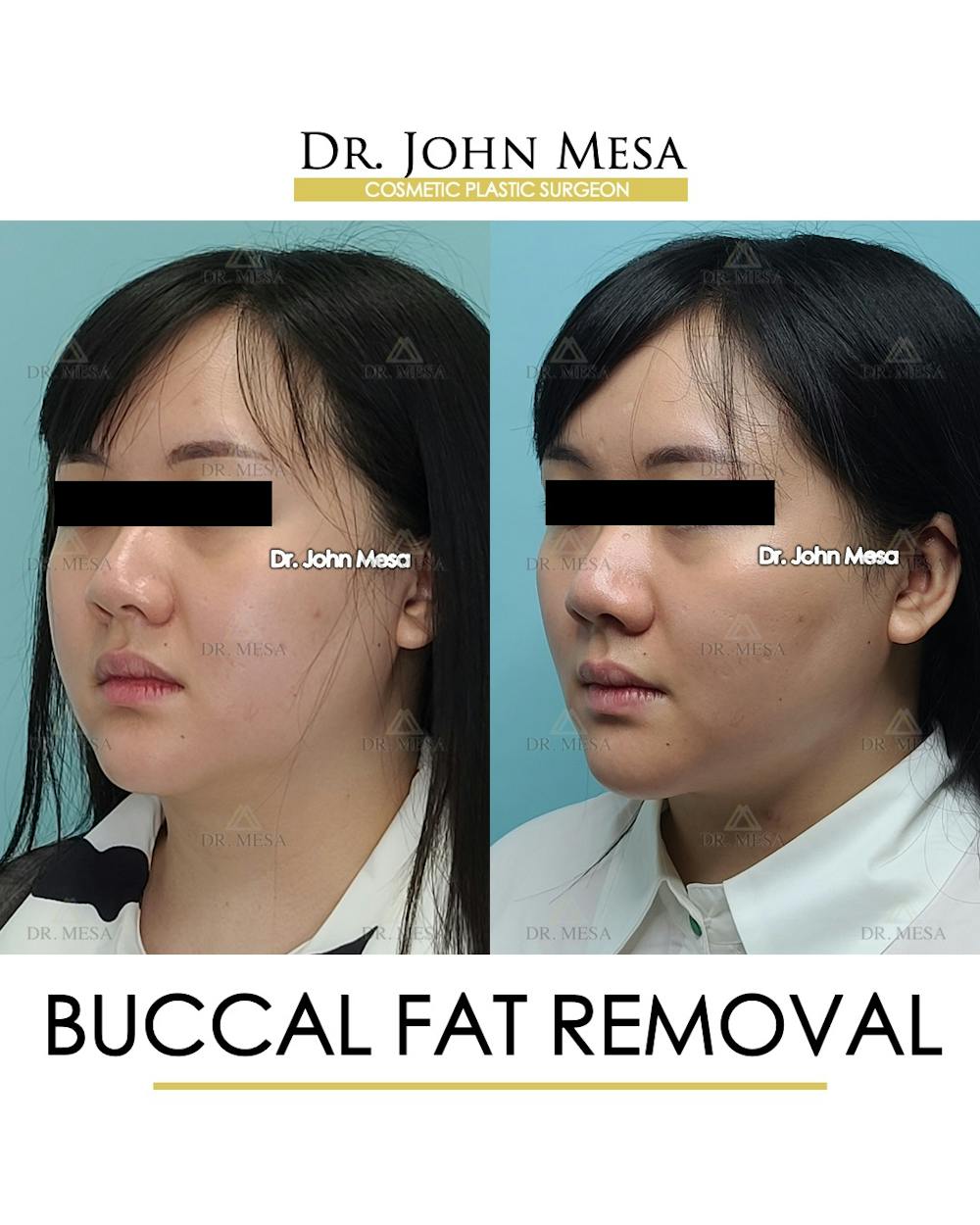 Buccal Fat Pad Removal Before & After Gallery - Patient 889395 - Image 3