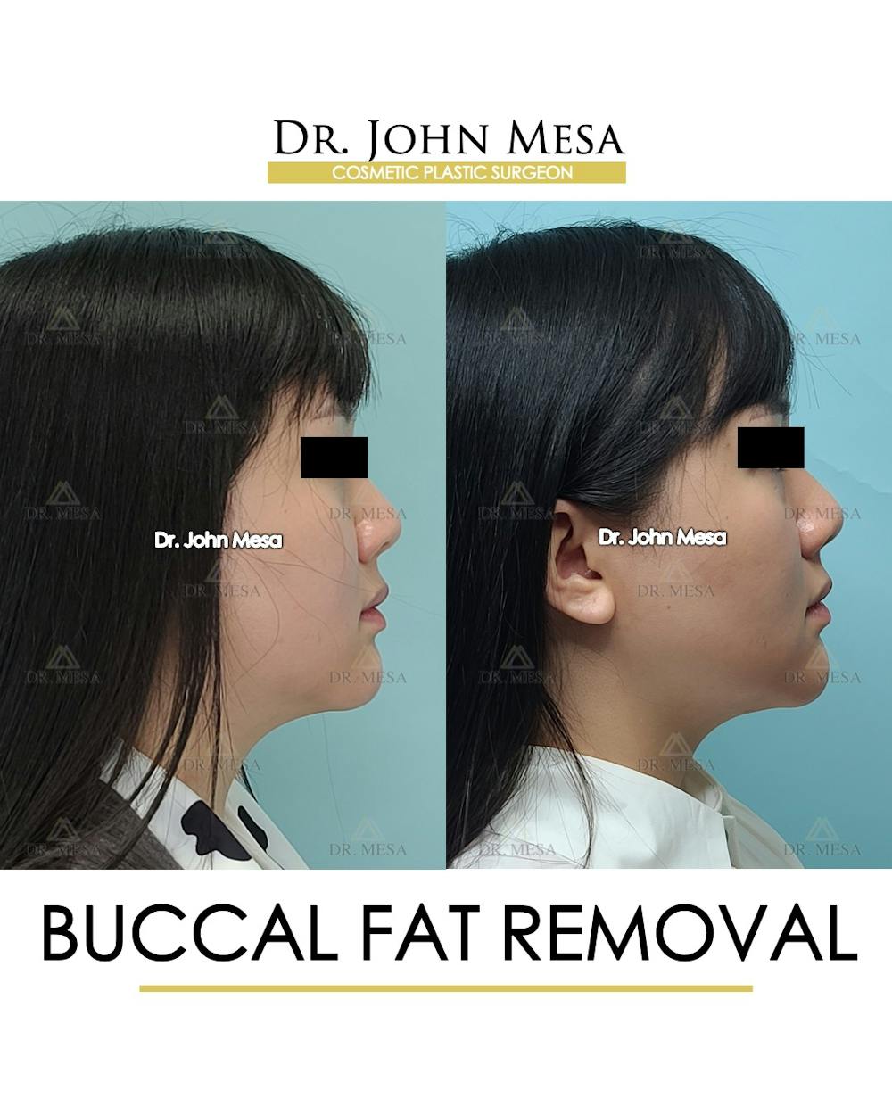 Buccal Fat Pad Removal Before & After Gallery - Patient 889395 - Image 4