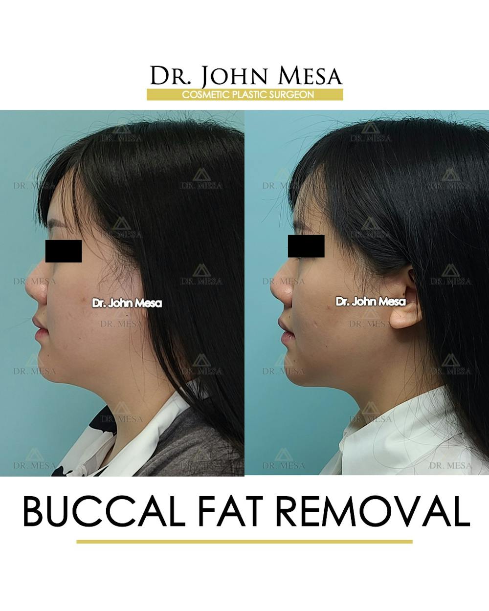 Buccal Fat Pad Removal Before & After Gallery - Patient 889395 - Image 5