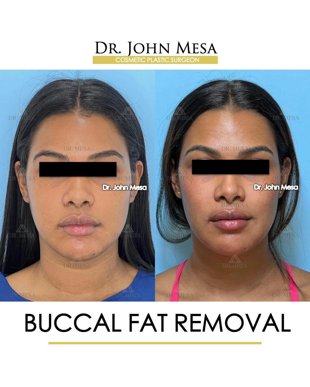 Buccal Fat Pad Removal Before & After Gallery - Patient 199889 - Image 1