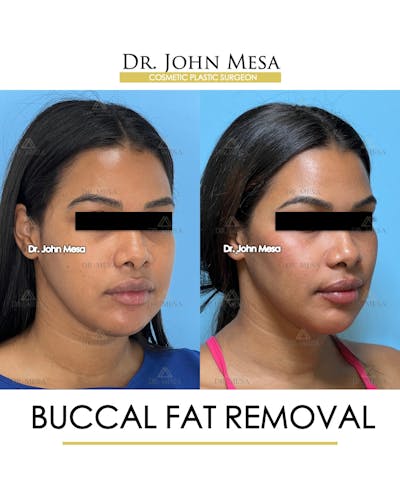 Buccal Fat Pad Removal Before & After Gallery - Patient 199889 - Image 2
