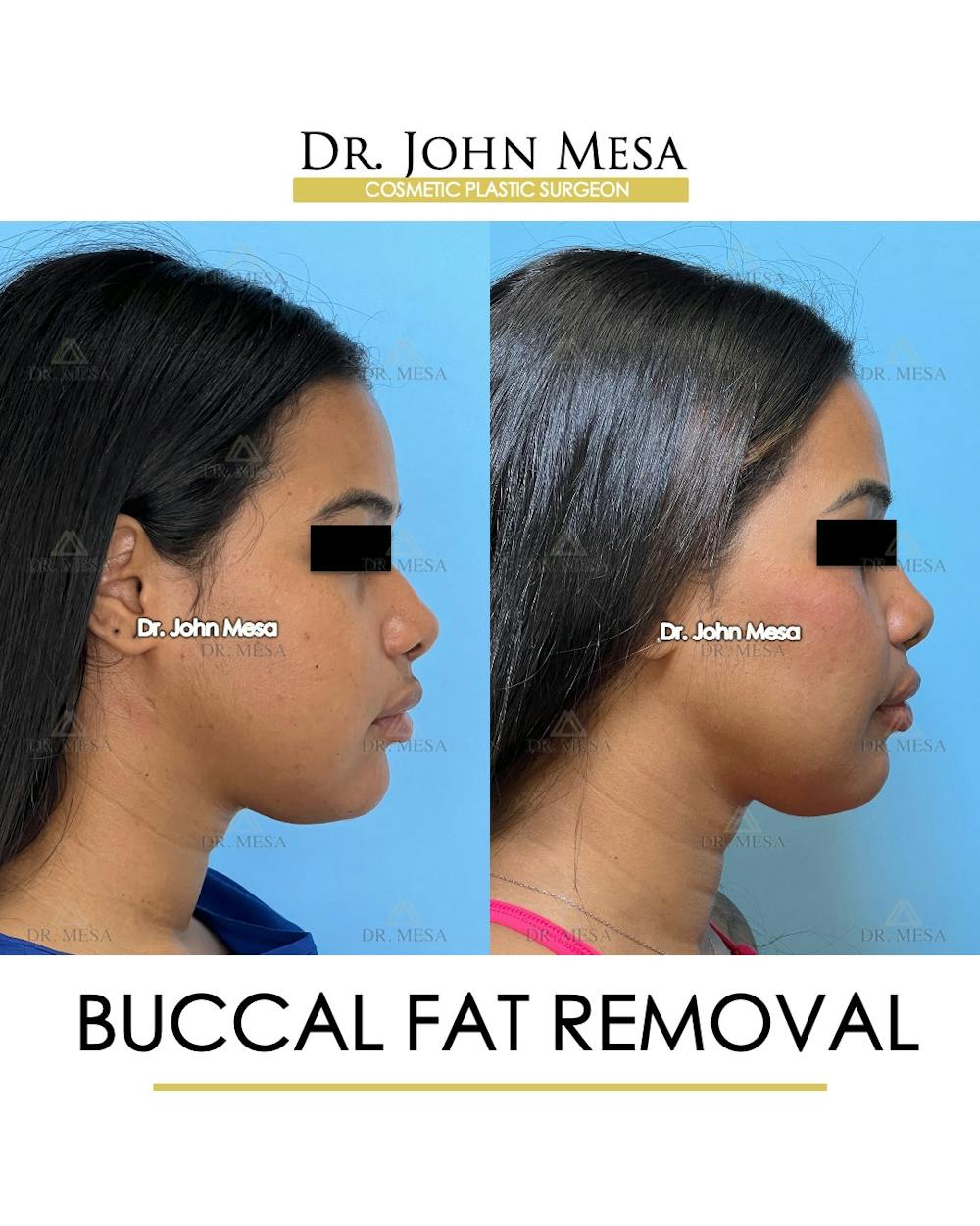 Buccal Fat Pad Removal Before & After Gallery - Patient 199889 - Image 3
