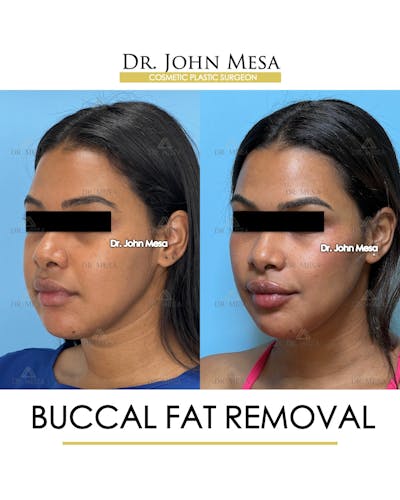 Buccal Fat Pad Removal Before & After Gallery - Patient 199889 - Image 4
