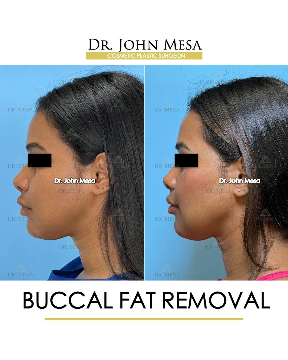 Buccal Fat Pad Removal Before & After Gallery - Patient 199889 - Image 5