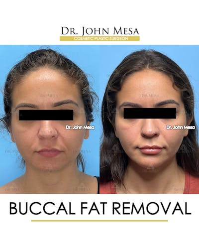 Buccal Fat Pad Removal Before & After Gallery - Patient 307682 - Image 1