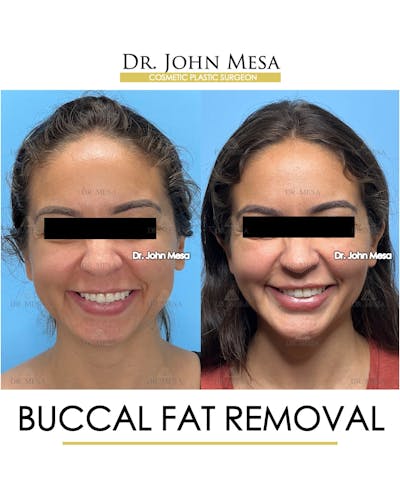 Buccal Fat Pad Removal Before & After Gallery - Patient 307682 - Image 2