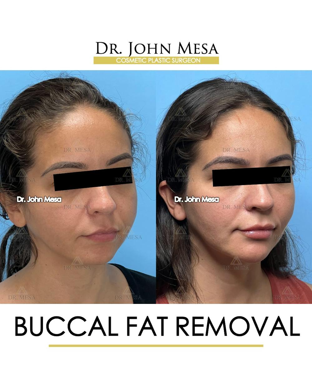 Buccal Fat Pad Removal Before & After Gallery - Patient 307682 - Image 3
