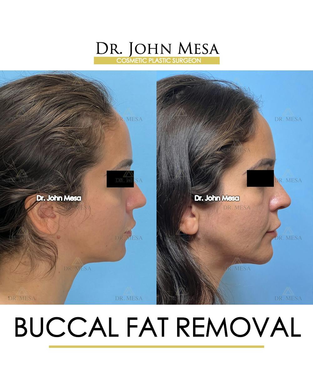 Buccal Fat Pad Removal Before & After Gallery - Patient 307682 - Image 4