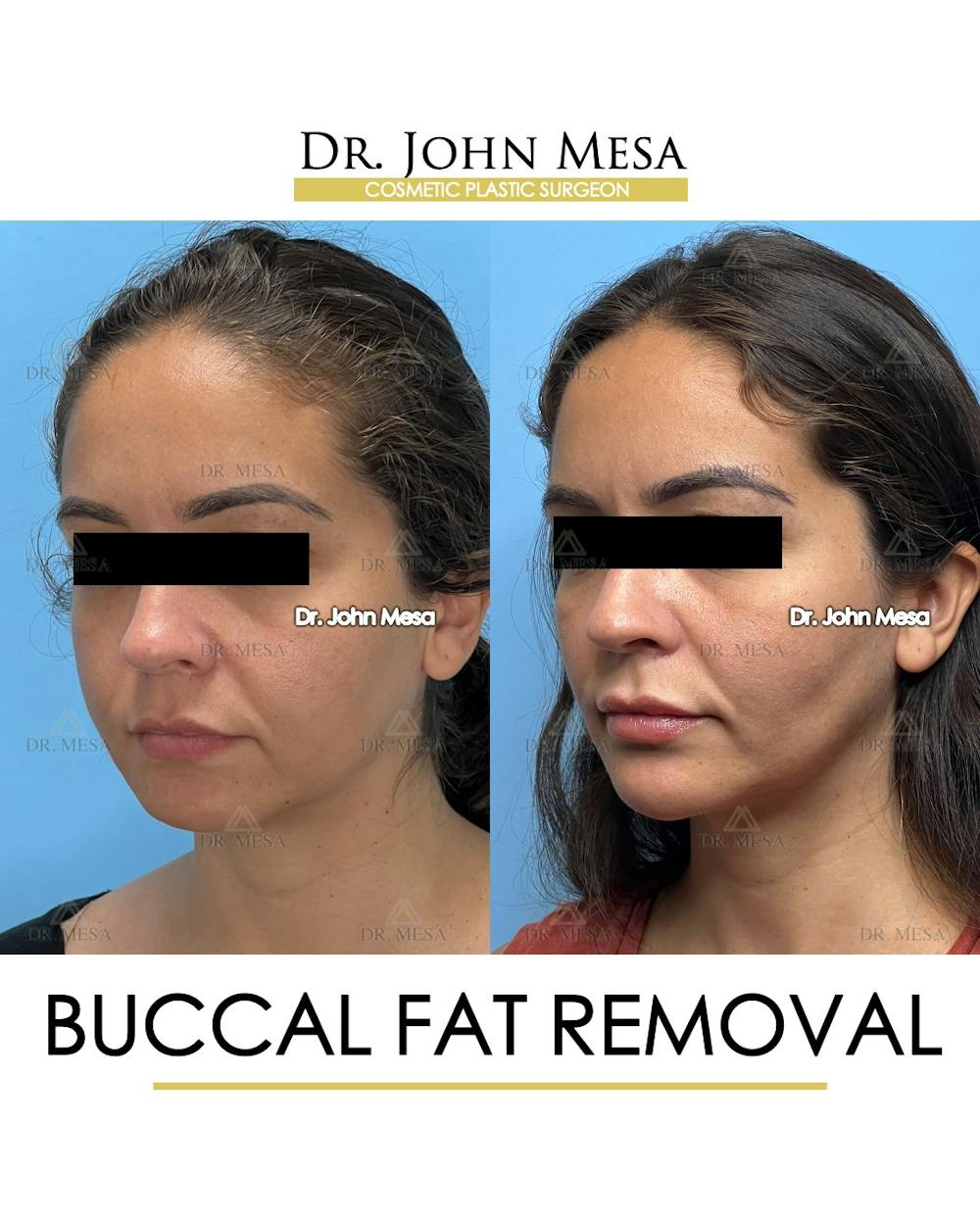 Buccal Fat Pad Removal Before & After Gallery - Patient 307682 - Image 5