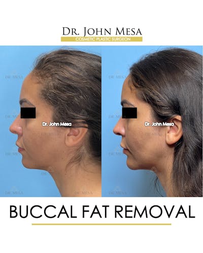 Buccal Fat Pad Removal Before & After Gallery - Patient 307682 - Image 6