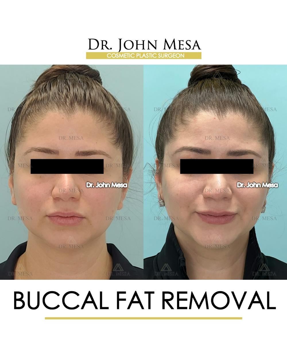 Buccal Fat Pad Removal Before & After Gallery - Patient 291095 - Image 1