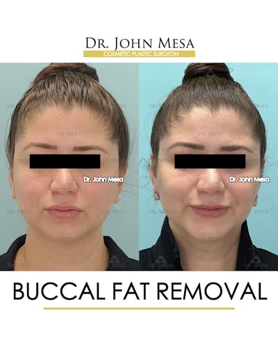 Buccal Fat Pad Removal Before & After Gallery - Patient 291095 - Image 1