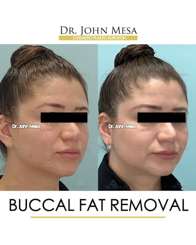 Buccal Fat Pad Removal Before & After Gallery - Patient 291095 - Image 2
