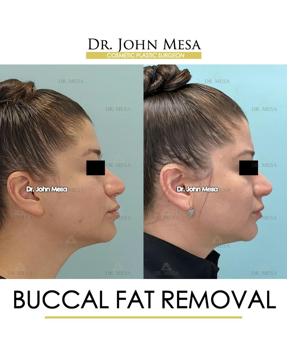 Buccal Fat Pad Removal Before & After Gallery - Patient 291095 - Image 3