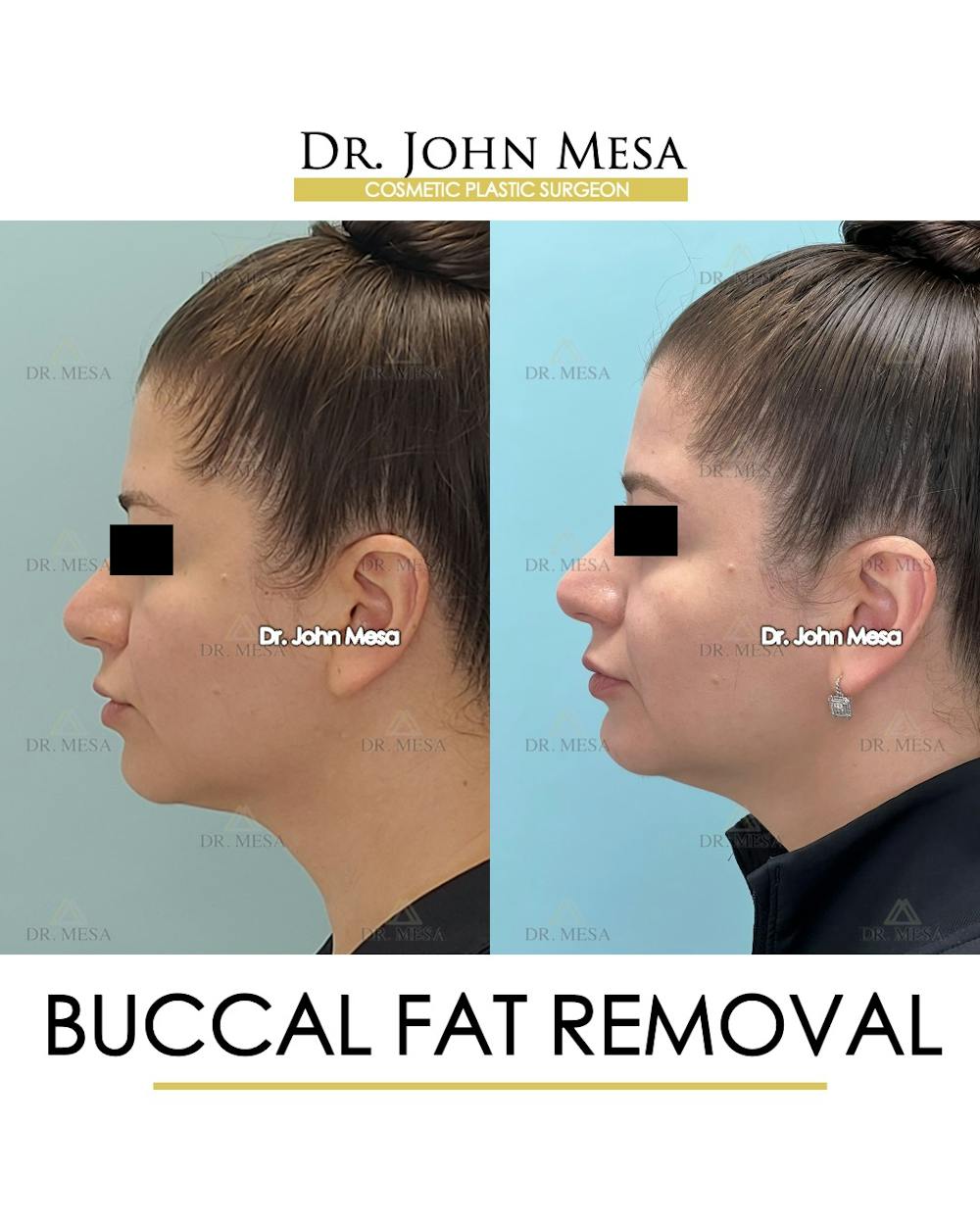 Buccal Fat Pad Removal Before & After Gallery - Patient 291095 - Image 5